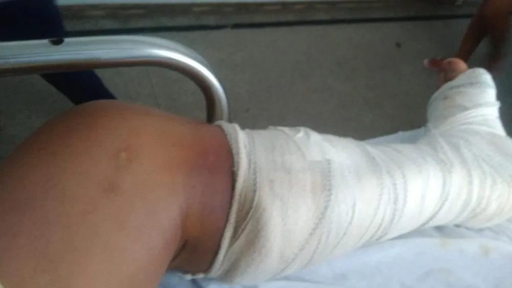Dados do SIM mostram que em 2023, cerca de 546 pessoas morreram vítimas de acidentes de trânsito no Tocantins, na foto já em recuperação jovem que quebrou a perna em acidente de moto no último domingo, Foto- Redação Notícia Tocantins.