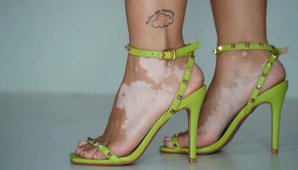 Para aumentar a conscientização, apoiar, educar e combater a desinformação sobre o vitiligo instituiu-se uma data comemorativa no Brasil.